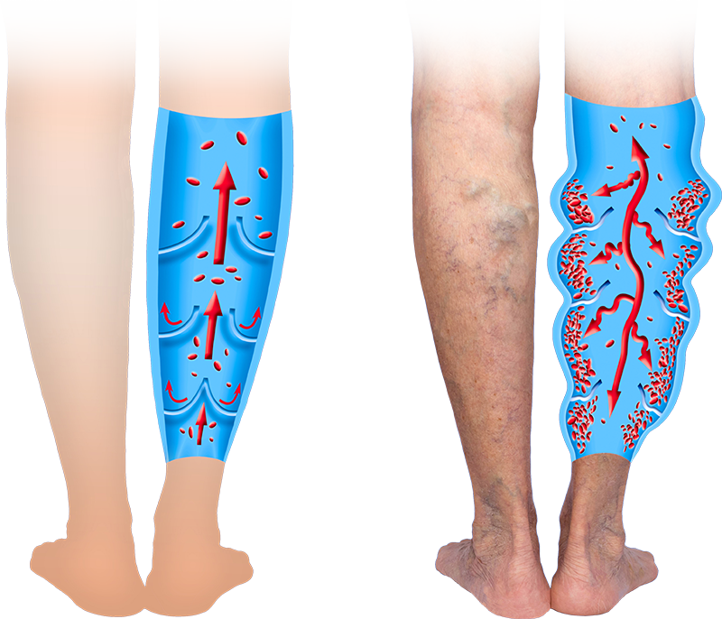 Vein Treatment - Diabetic Health and Wellness